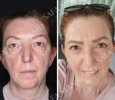 Face & Neck Lift & Combined Blepharoplasty