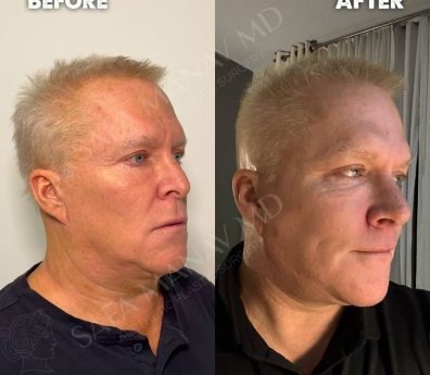 Facelift & Necklift